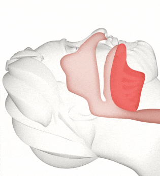 Animation of airway collapsing during Obstructive Sleep Apnea.