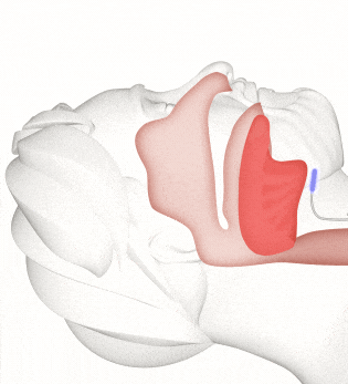 An animation of the Inspire therapy system keeping a sleeping person's airway open.