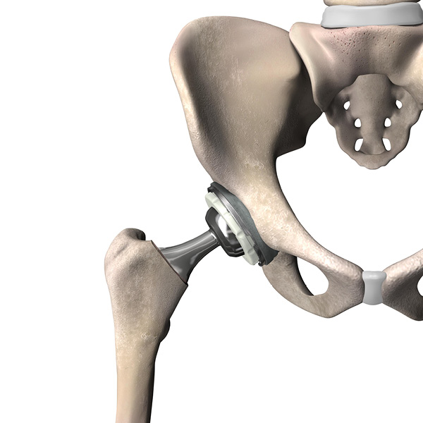 Total Hip Replacement PCI Orthopedics Eastern Iowa