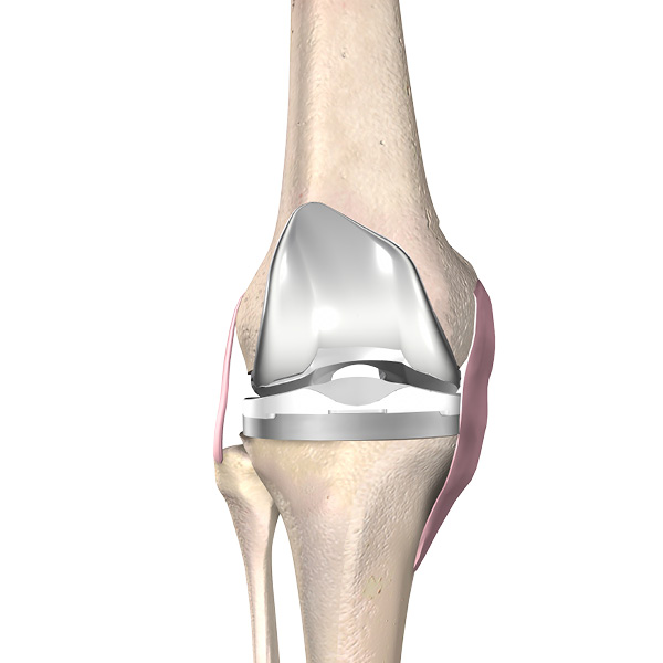 Knee Implant
