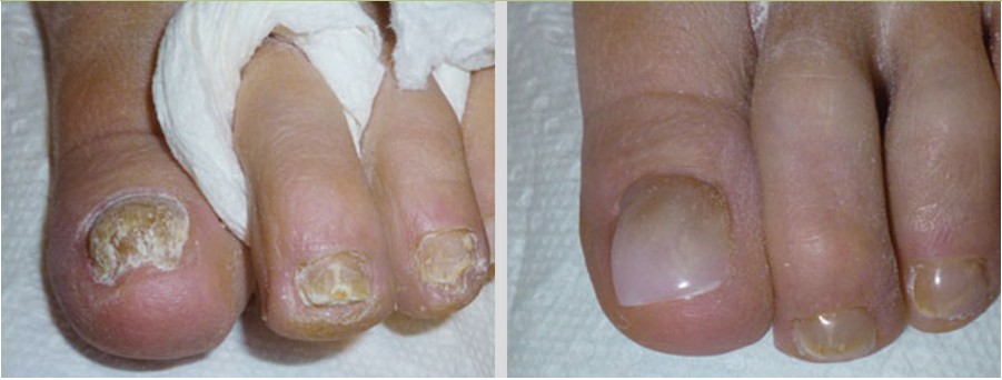 Before and after photo of damaged toenails treated with KERYflex