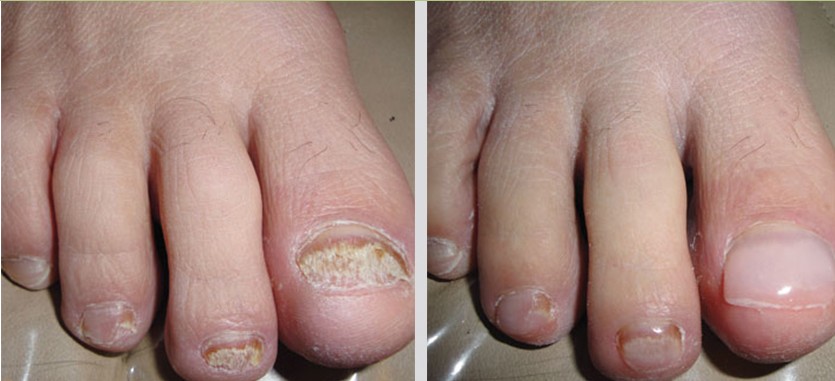 Photo of damaged toenail before and after